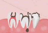 部分的な虫歯の場合