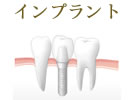 インプラント