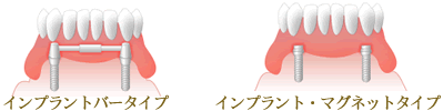 全ての歯を失った場合