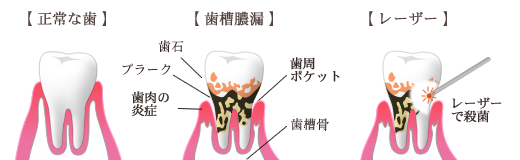 歯槽膿漏の症状