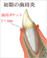 歯周病の進行