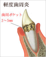 歯周病の進行
