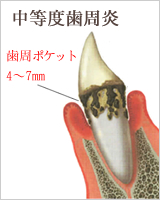 歯周病の進行