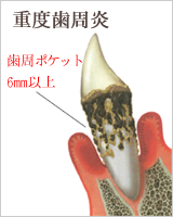 歯周病の進行