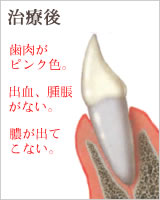 歯周病の治療
