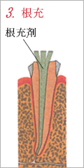 3.根充